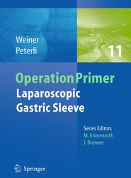 Laparoscopic Gastric Sleeve
