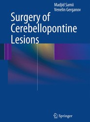 Surgery of Cerebellopontine Lesions