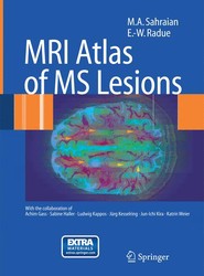 MRI Atlas of MS Lesions