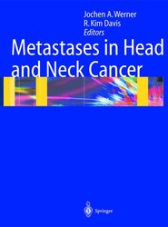 Metastases in Head and Neck Cancer