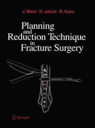 Planning and Reduction Technique in Fracture Surgery