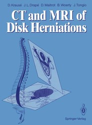 CT and MRI of Disk Herniations