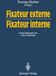 Fixateur externe - Fixateur interne