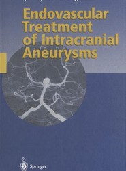 Endovascular Treatment of Intracranial Aneurysms