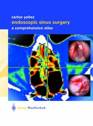 Endoscopic Sinus Surgery