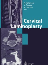 Cervical Laminoplasty