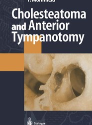 Cholesteatoma and Anterior Tympanotomy