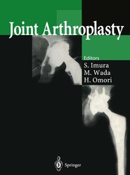 Joint Arthroplasty