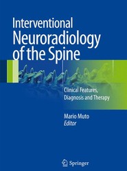 Interventional Neuroradiology of the Spine