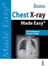 Chest X-ray Made Easy