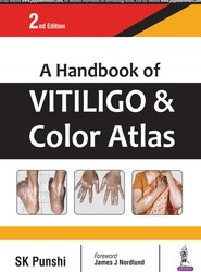 A Handbook of Vitiligo & Color Atlas