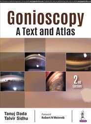 Gonioscopy: A Text and Atlas