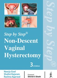 Step by Step: Non-Descent Vaginal Hysterectomy