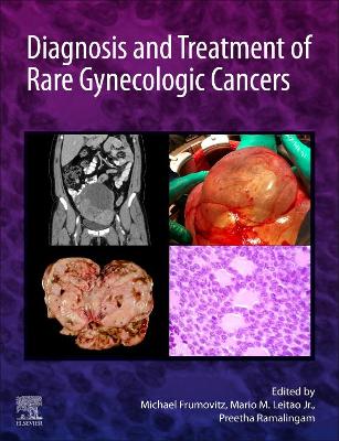 Diagnosis and Treatment of Rare Gynecologic Cancers