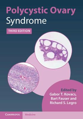 Polycystic Ovary Syndrome