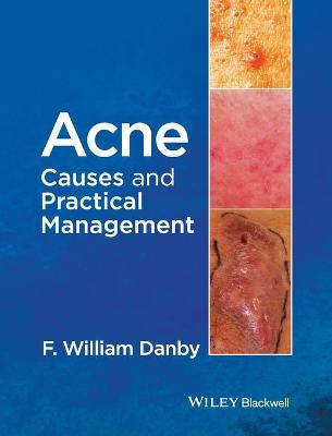 Acne - Causes and Practical Management