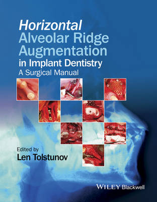 Horizontal Alveolar Ridge Augmentation in Implant Dentistry - A Surgical Manual