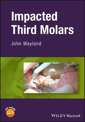 Third Molar Extraction