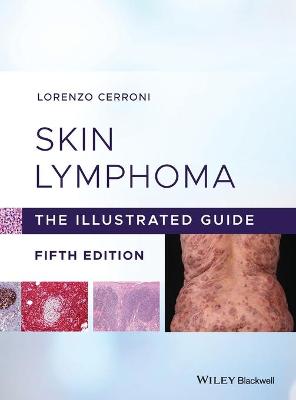 Skin Lymphoma - The Illustrated Guide