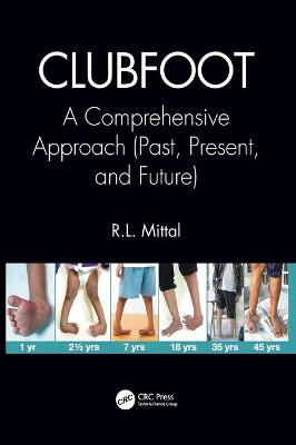 Clubfoot