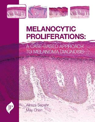 Melanocytic Proliferations