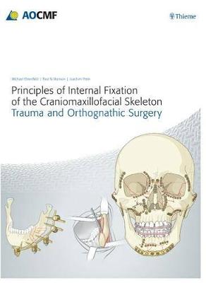Principles of Internal Fixation of the Craniomaxillofacial Skeleton