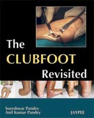 The Club Foot Revisited