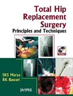 Total Hip Replacement Surgery