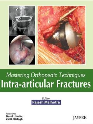 Mastering Orthopedic Techniques: Intra-Articular Fractures