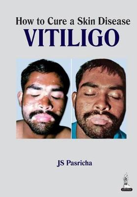 How to Cure a Skin Disease: Vitiligo