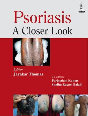Psoriasis