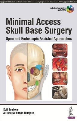 Minimal Access Skull Base Surgery
